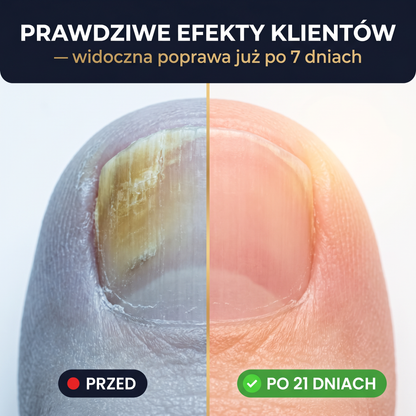 2 opakowania w cenie 1 — paznokcie jak nowe w 21 dni✨